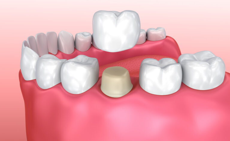 Implantat Zahnarzt Skizze
