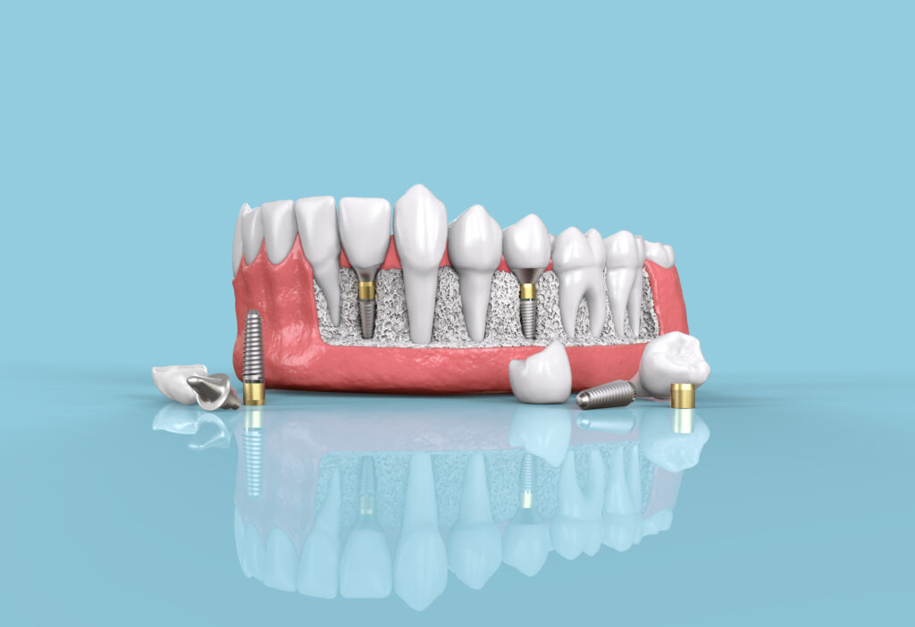 Implantat Zahnarzt 3D Modell